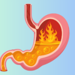 How to Get Rid of Heartburn: Effective Remedies and Prevention Tips