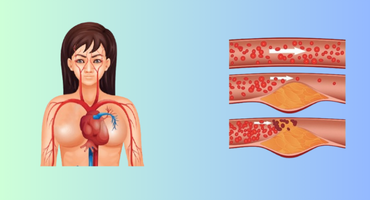 7 Signs That Indicate Clogged Arteries