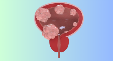 What Are the 5 Warning Signs of Bladder Cancer?