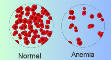 Early Warning Signs of Anemia You Really Shouldn’t Ignore